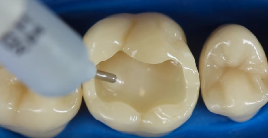 Plombe Dentare